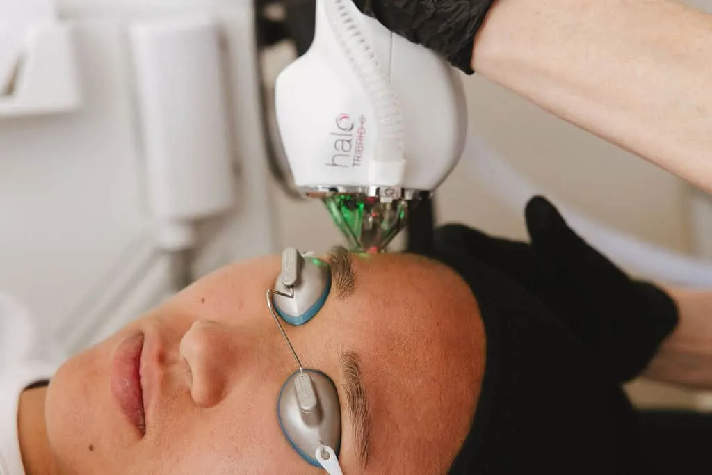 A Sciton HALO laser treatment in progress at Salmon Creek Plastic Surgery