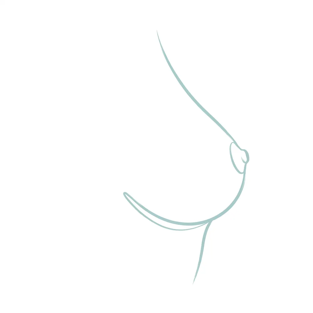 Diagram showing the inframammary incision in the fold beneath the breast