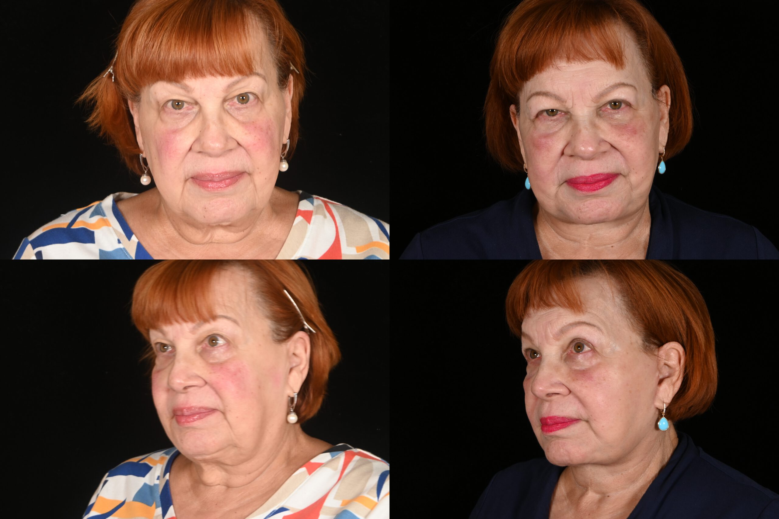 Facelift 79 year-old-female