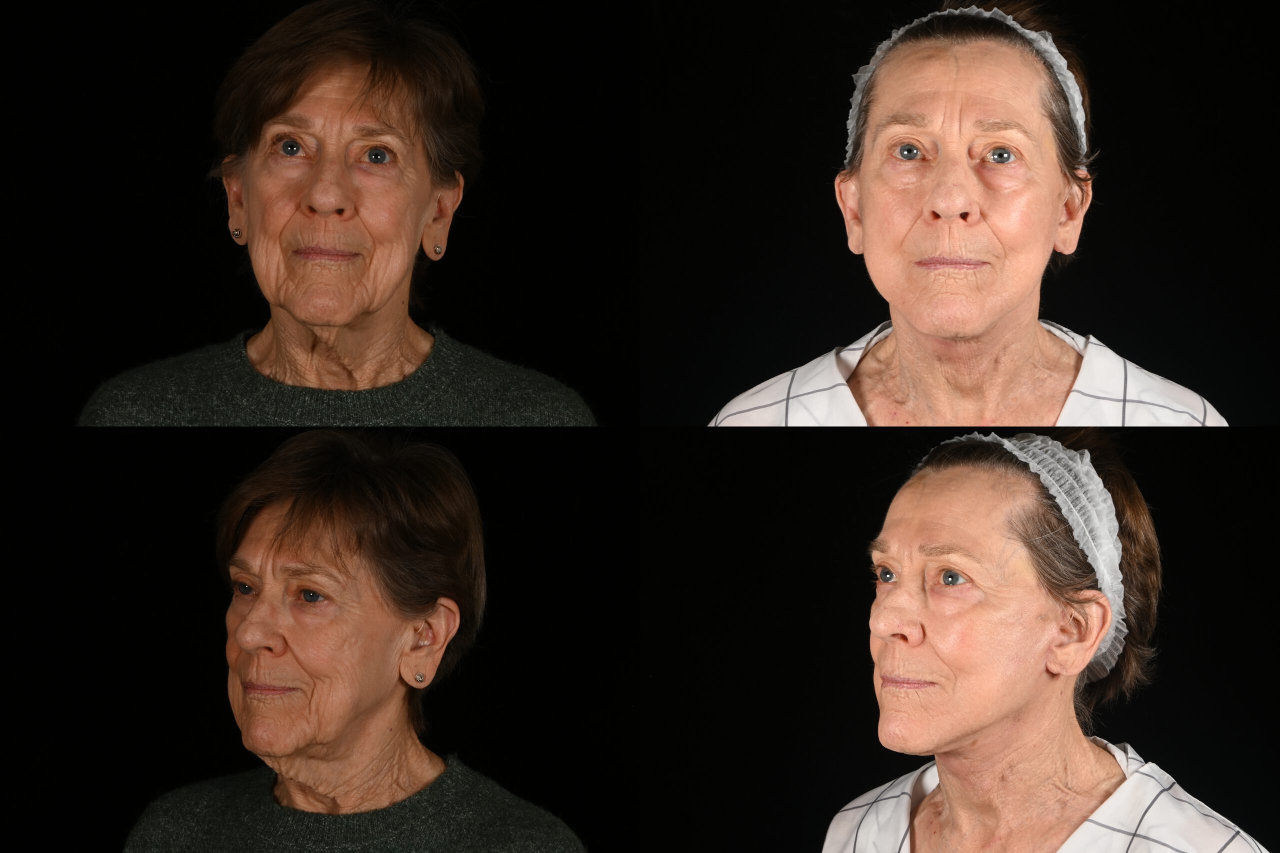 77-year-old female, deep plane facelift