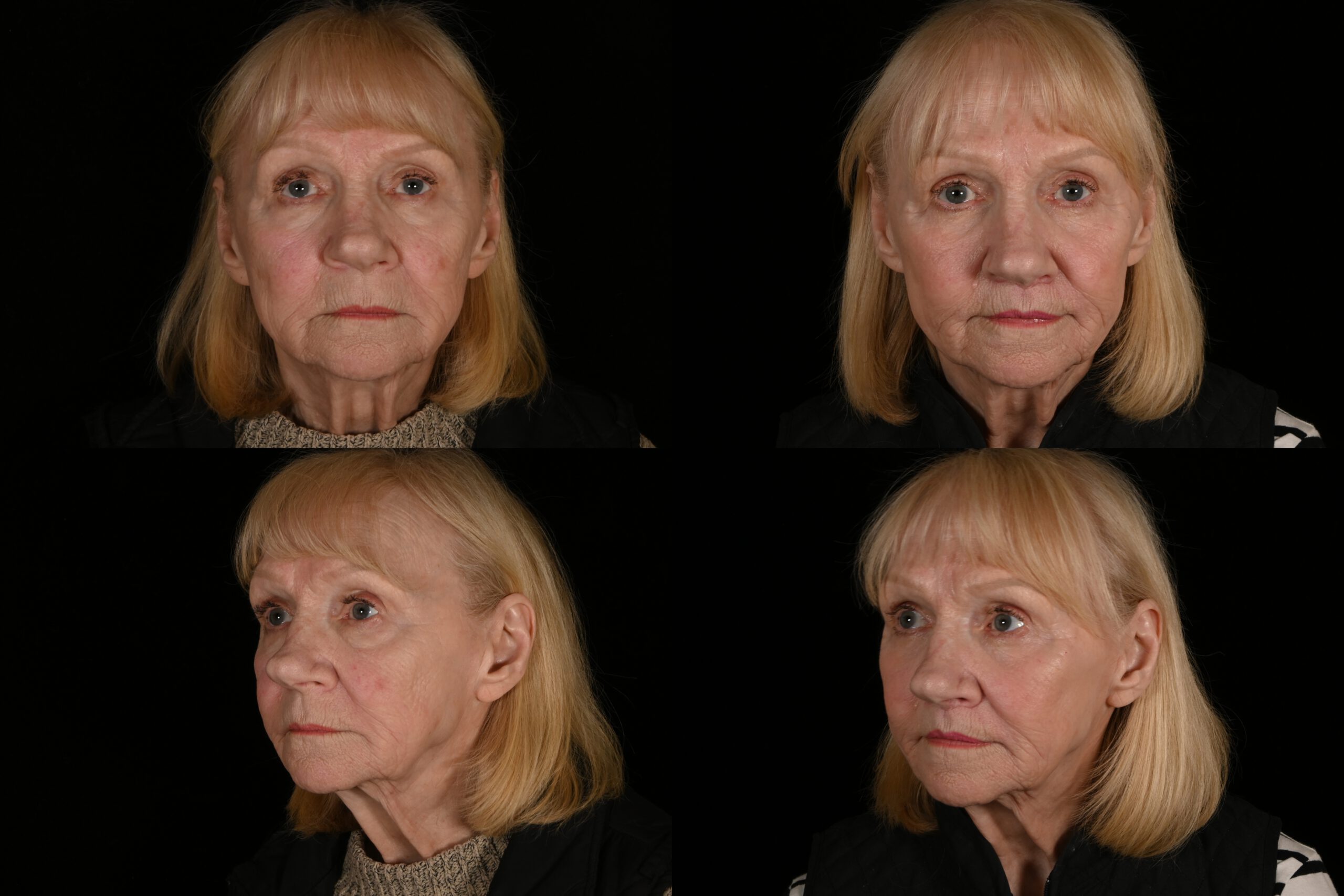 77-year-old female lip lift