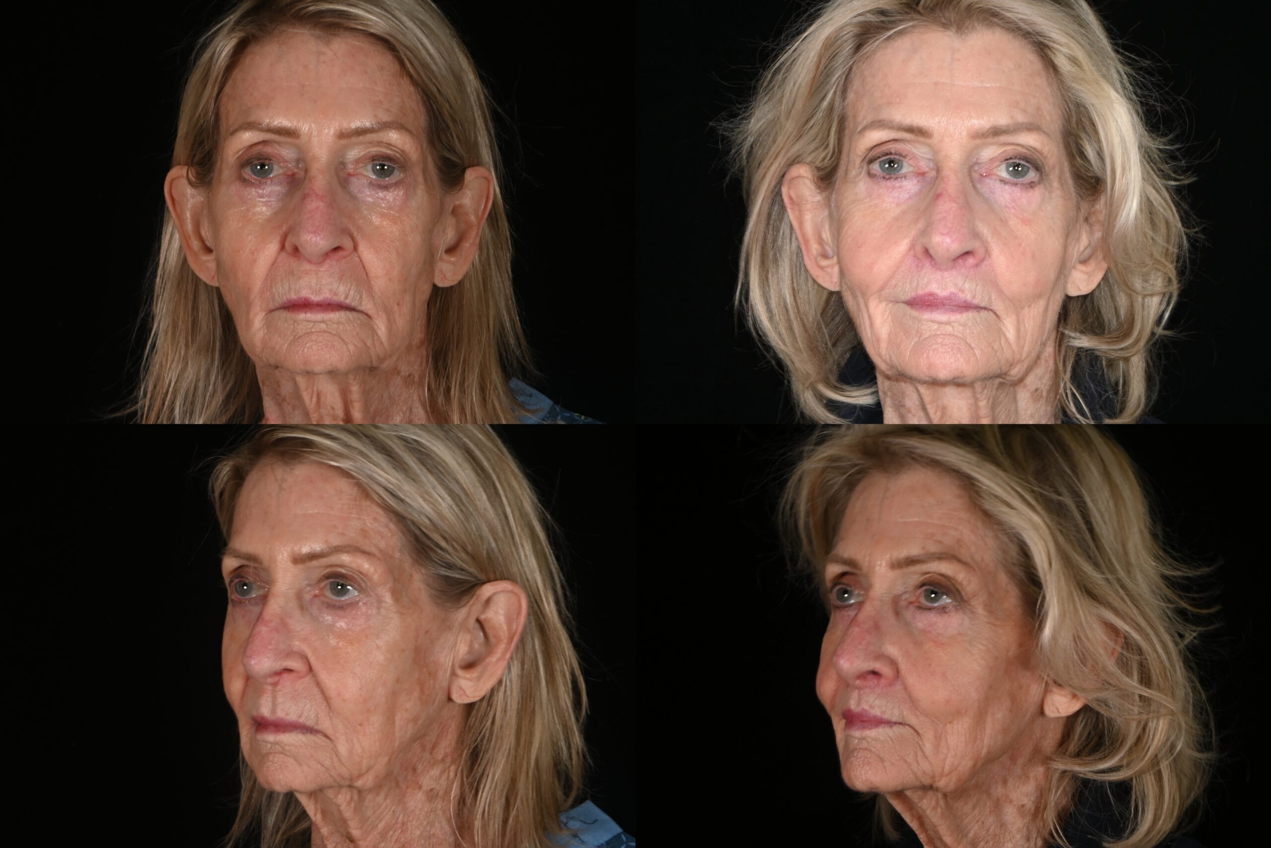 78-year-old female, lip lift