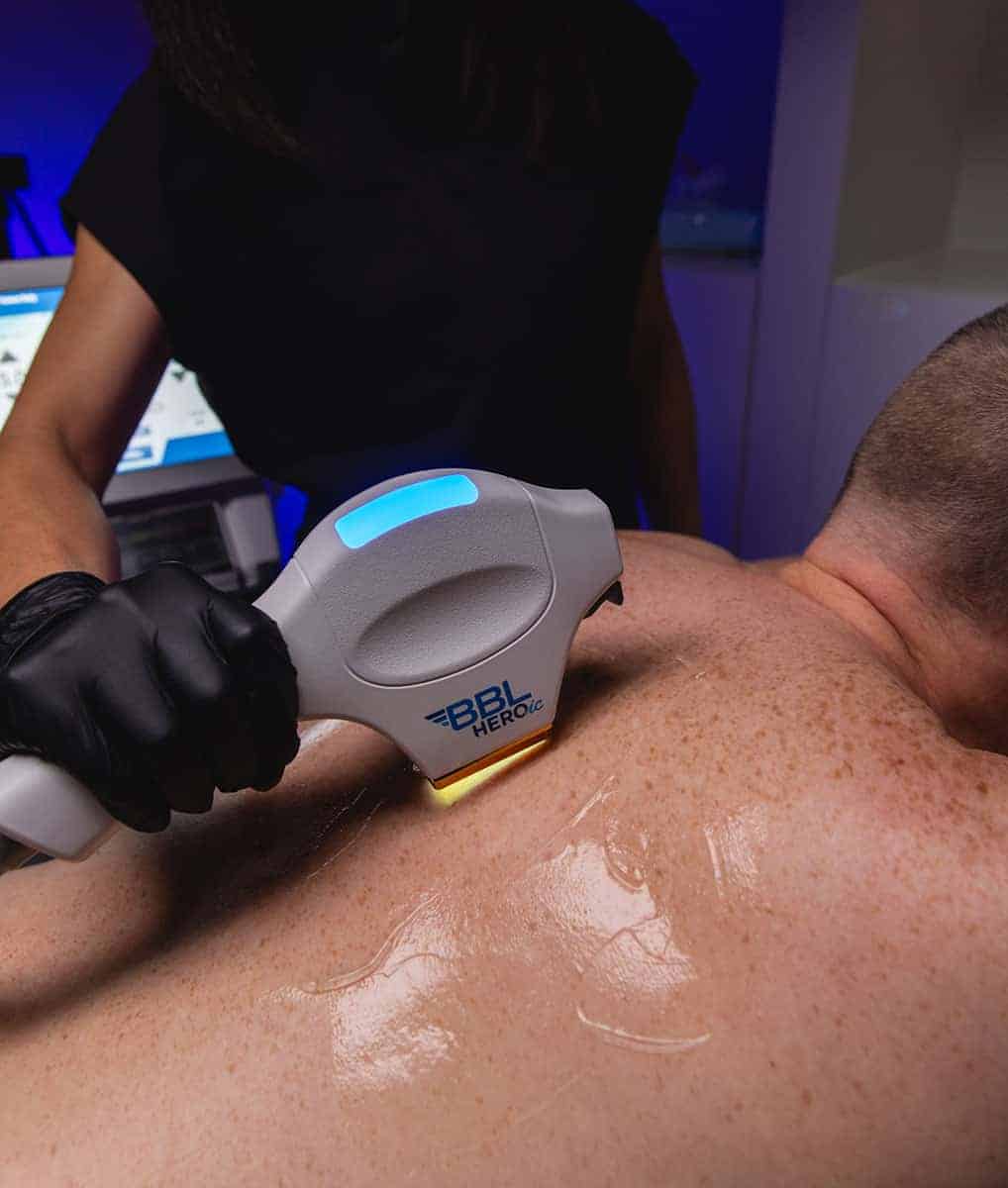 A tech works on hair removal using the FOREver Bare BBL laser